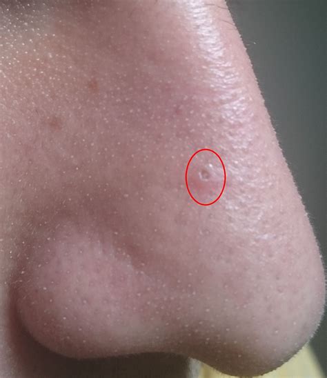 This biggest dilated pore of 30