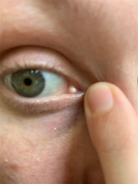 What is this white ball in the very corner of my eye?! : medical