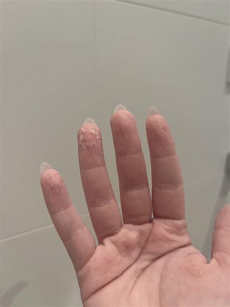 [misc] Skin is constantly peeling off and making me feel so uncomfy