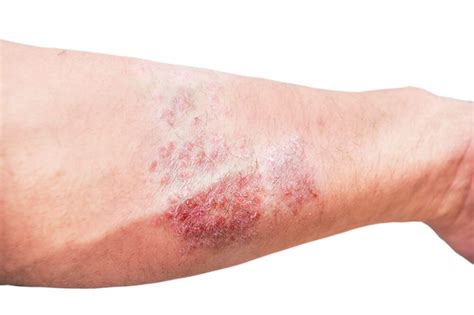dermatitis  eczema treatment brisbane skin dermatologists
