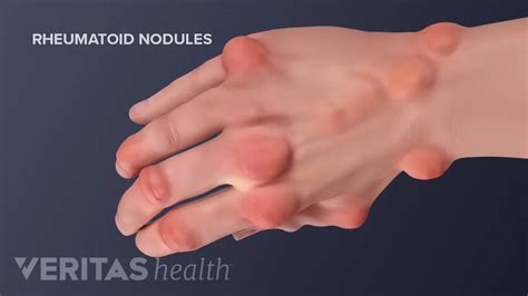 rheumatoid arthritis nodules  fingers