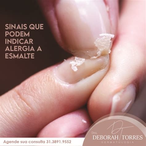 Alergia A Esmalte Sintomas - Sinais que podem indicar alergia a esmalte - Líder Notícias | A ...