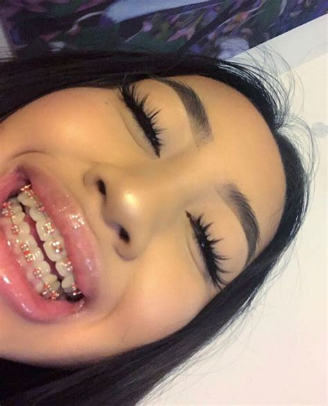 Orthodontic Braces Colors at Trent Ragland blog