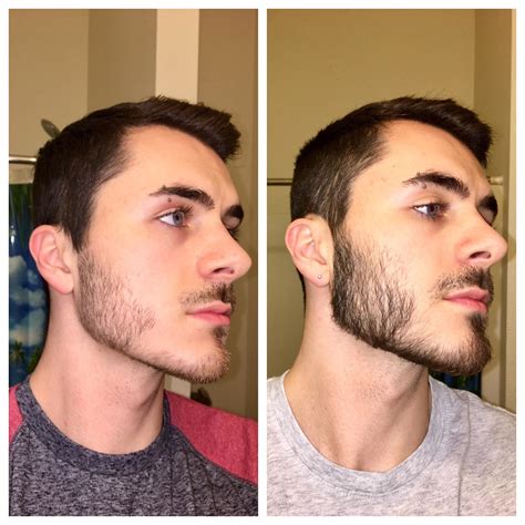 Minoxidil Beard Growth Real Before And After Photos | My XXX Hot Girl