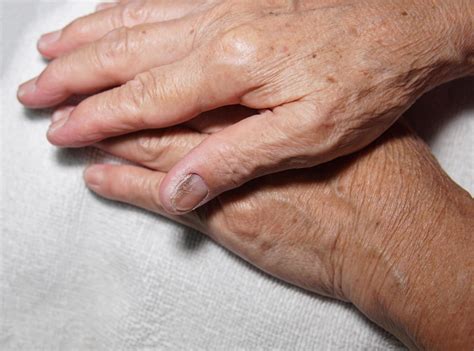 Fingernail of an elderly woman infected with fungal infection. 8060144