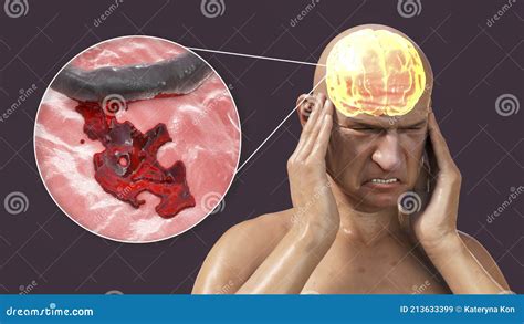 Brain Blood Clot Royalty-Free Illustration | CartoonDealer.com #69847503