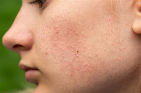 How to Treat Comedones? | Neutrogena® Skincare