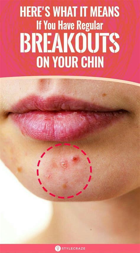 Pin on Beautiful all skin and clean chin