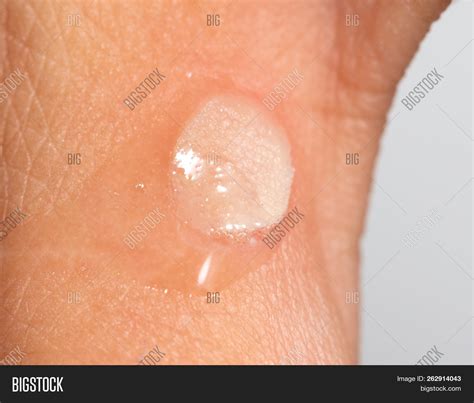 Hydrogen Peroxide On Image & Photo (Free Trial) | Bigstock