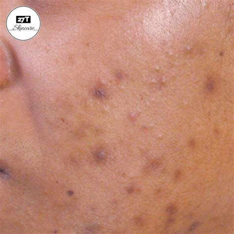 tham  va tham den nguyen nhan cach dieu tri tung loai tham mun