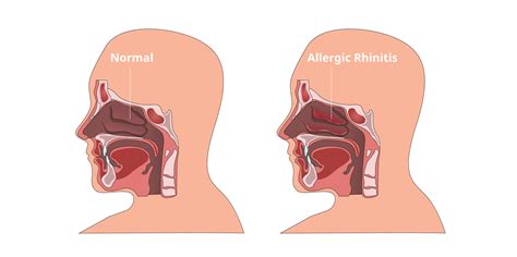 Rhinitis Icd 10 5