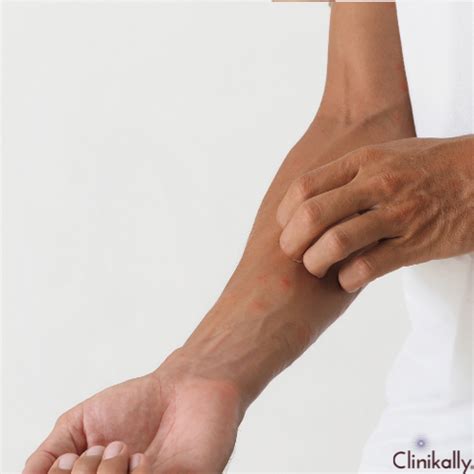 Difference Between Rash and Hives? Doctor's Guide | Clinikally