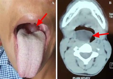 Vallecular cyst causes, symptoms, diagnosis & treatment