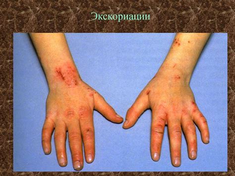 Морфологические элементы кожных сыпей - презентация онлайн