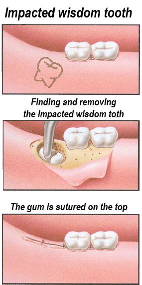 Surgical removal of an impacted wisdom tooth | Ralev Dental Clinic