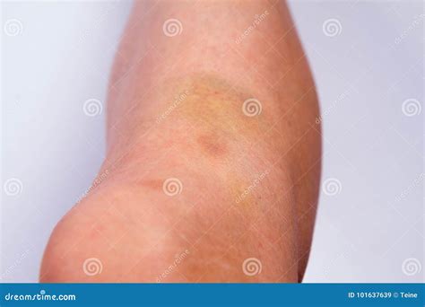 Bruised leg stock image. Image of fight, punch, womans - 101637639