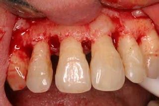 clinical dental advantages   apically positioned flap perio