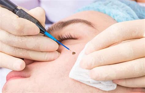 wart removal understanding types   effective treatment