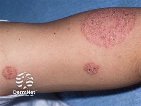 discoid eczema images dermnet