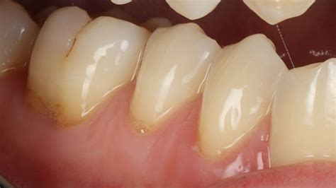 The Best Home Treatments for Exposed Tooth Roots - GDG