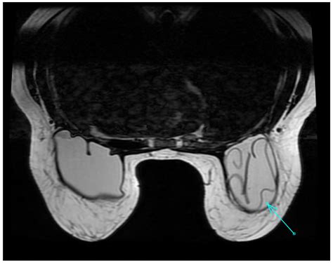 Medical Imaging of Inflammations and Infections of Breast Implants