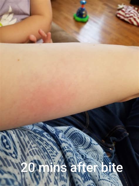 Confirmed Brown Recluse Bite : r/spiders