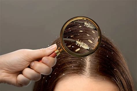 Cómo Eliminar Las Liendres Del Pelo Y Remedios Naturales • Pelo Natural