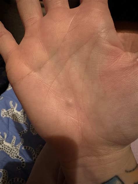 Bluish lump in hand : r/DermatologyQuestions