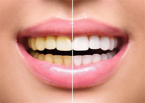 Teeth Whitening Mandurah | Platinum Smile Dentist Mandurah