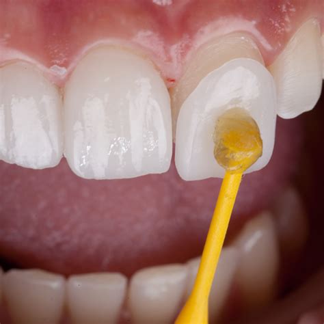Coloquei Facetas De Porcelana E Não Gostei