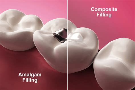 amalgam fillings