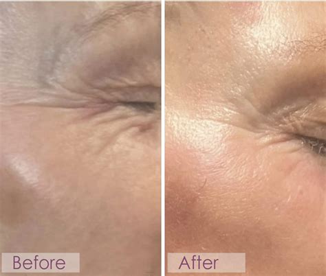 micro needling | Nu Cell Skin Rejuvenation