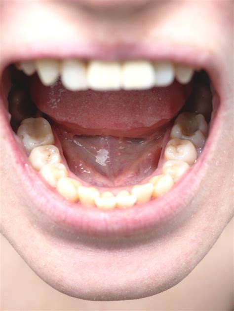Cancer De Lingua Estagio Inicial - Cancer De Lingua Em Estagio Inicial Câncer De Boca Sintomas,