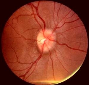 Papilledema Pictures, Symptoms, Causes, Treatment