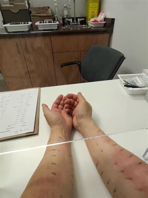My arms after the allergy prick test : r/pics