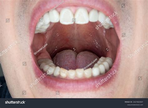 caucasian male open oral cavity close stock photo  shutterstock