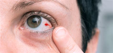 derrame ocular clinica cadi