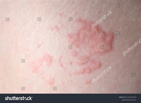 Hives Nettle Rash On Human Skin Stock Photo 2187225623 | Shutterstock