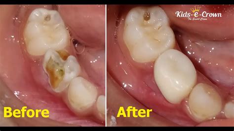 Dental Crown Back Molar at Kent Richardson blog