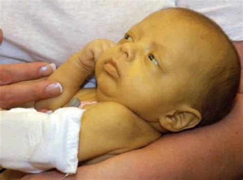 O Que É Ictericia Neonatal - Icterícia Neonatal: o que é, causas, como ocorre, tipos e valores de ...