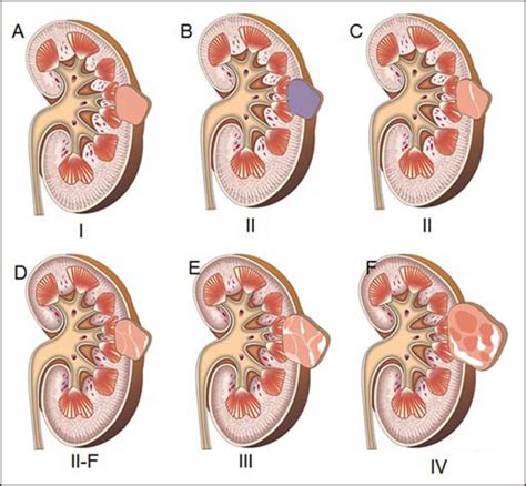Foods Good For Kidney Cysts at Bruce Schmidt blog