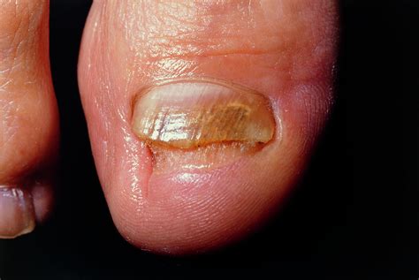 Toes Diseases Pictures Photos - Bank2home.com