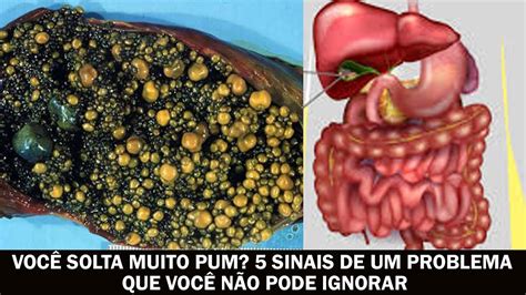Solta Muito Pum É Normal - Você solta muito pum? 5 sinais de um problema que você não pode ignorar ...