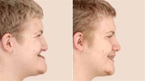 Severe Underbite