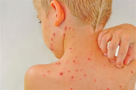 5 home remedies for chickenpox | Fox News