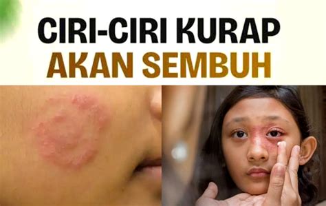 ciri ciri kurap  sembuh   mencegahnya timbul kembali