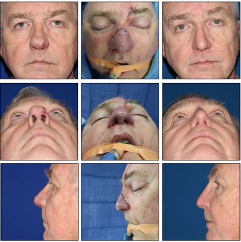 forehead flap