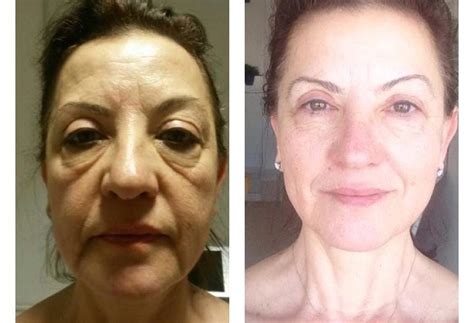 endoscopic face endoscopic facelift facelift prices minimally