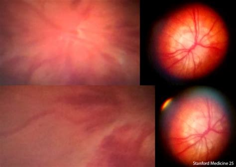 Fundoscopic Exam Abnormal Findings