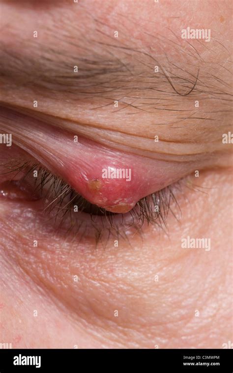 chalazion cyst  res stock photography  images alamy